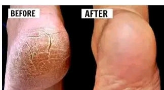 WaYFaR Foot Crack Cream For Dry Cracked Heels & Feet (50gm) Pack of 1