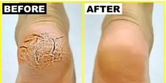 WaYFaR Foot Crack Cream For Dry Cracked Heels & Feet (50gm) Pack of 1